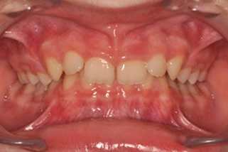 Sobremordida - Antes