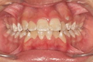 Sonrisa Gingival - Antes