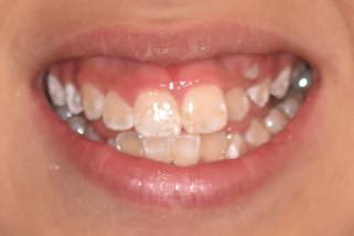 Sonrisa Gingival Antes