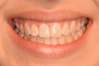Sonrisa Gingival Después