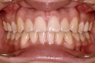 Apiñamiento dental en adolescentes corregido