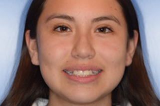 Apiñamiento dental en adolescentes