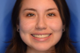 Apiñamiento dental en adolescentes corregido