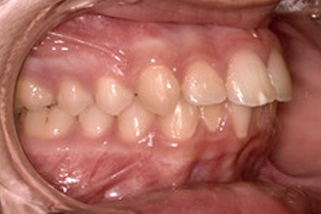 Dientes salidos