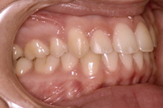 Dientes salidos después
