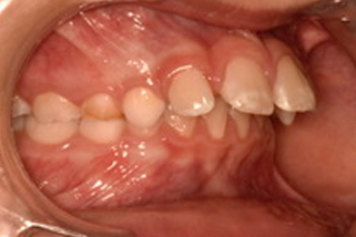 Dientes protruidos o salidos