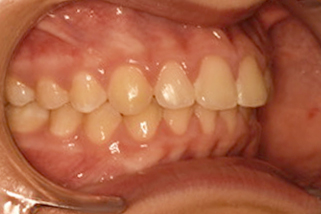 Dientes protruidos o salidos corregidos