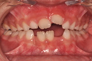 Mordida abierta anterior