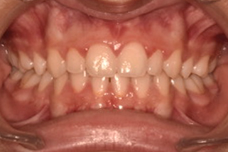 Mordida abierta anterior Después