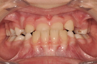Mordida cruzada anterior